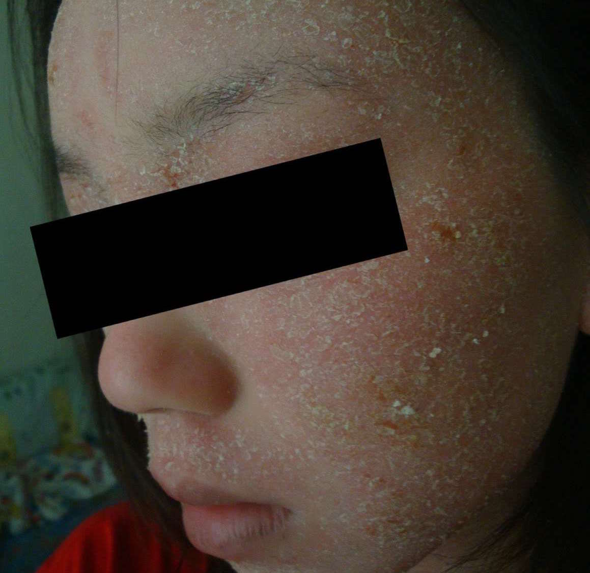 How I Made It Through 4 Years of Topical Steroid Withdrawal, And How It Changed Me - Juliana, TSW RSS, Singapore